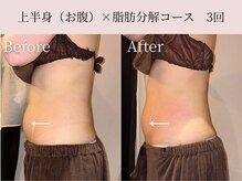 ミア(miiia)/上半身×脂肪分解コース　6回