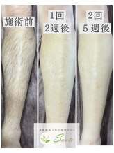 サンテ(Sante)/メンズ脱毛
