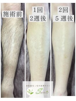 サンテ(Sante)/メンズ脱毛