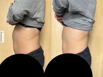 マイティー整骨院 ココア(CoCoa)/痩身マシン