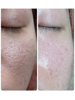 ソリッジ肌管理室/毛穴ケア