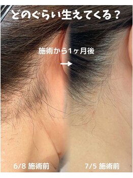 サロンドベルム(Salon de BELME)/ダブル脱毛:施術から1ヶ月後