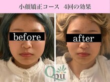 キュープ 表参道店(Qpu)/小顔矯正4回コースの変化