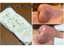 リーインカーナ アーティスト(REINCARNA ARTIST)の雰囲気（毛穴/黒ずみ/角栓除去【一回で効果実証】ハイドラ吸引→￥4000）