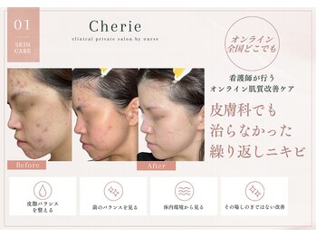 シェリー(Cherie)の写真/【繰り返す毛穴・ニキビ・肌トラブルにお悩みの方へ。自分に自信を取り戻したい方の本格ケア】