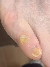 ランカ(RUNKA)/小指の魚の目