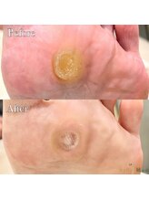 巻き爪補正店 つくば店/【硬いタコ/魚の目ケア】