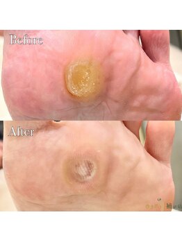 巻き爪補正店 つくば店/【硬いタコ/魚の目ケア】