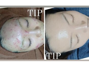 ムーンリズム(Moonlism)/【TIPハーブ症例】ニキビ/肌荒れ