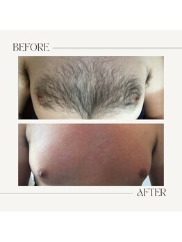 スプランドゥール(Splendeur)/メンズ【胸】WAX+光