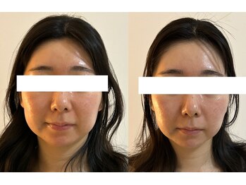 シアワセ(shiAwase)/【大阪本町】小顔矯正 B/A変化