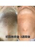 【初回限定◎】人気No1！ヒゲ脱毛　☆カウンセリング込み☆
