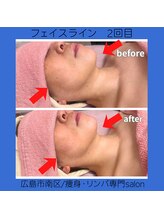 リラ(Lilas)/【小顔】二重顎撃退コース2回目