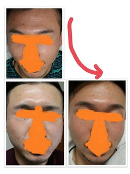 ベビースキン(baby skin)/肌改善