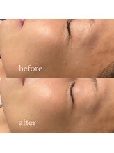 エムアンドユウ(m&u)/ほうれい線・しわ対策