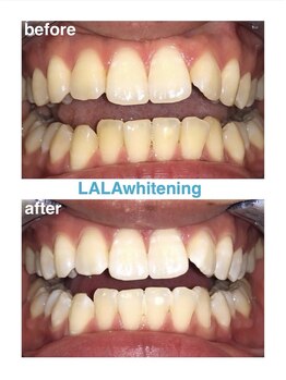 ララホワイトニング/Before&After強力ホワイトニング
