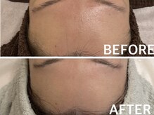 ハーブピーリング 恵比寿/インナードライ/肌管理/肌質改善