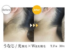 アルゴ 春日那珂川店(ALGO)/うなじもオススメ！WAX＋光脱毛