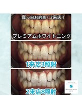 ホワイトニングビューティー 吉祥寺店&nbsp;歯を 白くする