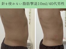 ソルニス(Solnis.)/痩身☆脂肪分解/ハイパーナイフ