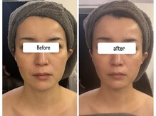 アリィ(Alii)/1度の変化リフトアップと小顔