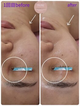 ピウリ(PIURI)/Before→After 目元くすみ改善♪