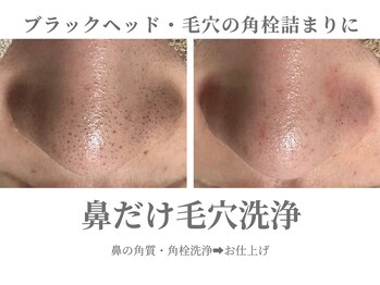 エクラ イオンモール徳島店(ECLAT)/鼻だけ毛穴洗浄