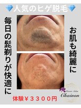 シェノン(Chainon)/ヒゲ脱毛