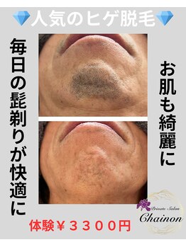 シェノン(Chainon)/ヒゲ脱毛