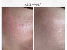 施術回数1回/新メニューのセルプラは顔のお悩みを改善