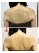 ベビースキン(baby skin)/背中ニキビ改善