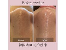 韓国式3D毛穴洗浄1回での変化☆