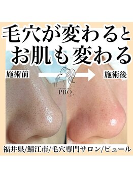 ピュール 鯖江店(PUR)/毛穴/毛穴ケア/毛穴洗浄