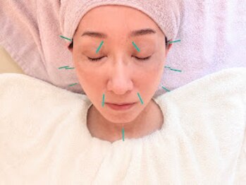 アカシア鍼灸整骨院の写真/季節の変わり目の肌トラブルには【美容鍼灸】血流改善・ターンオーバー促進！肌質改善ができる根本改善美容