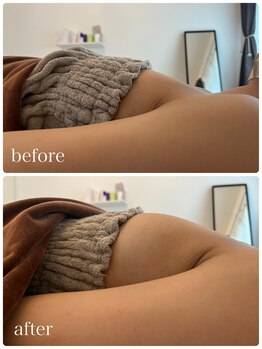 リノ 行橋(lino)/◇バストアップ症例◇30代