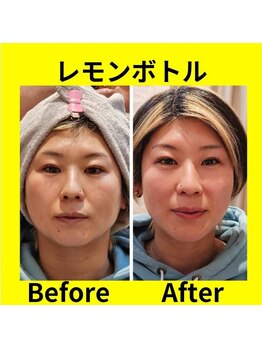 アン 銀座(ann)/レモンボトル 1回目