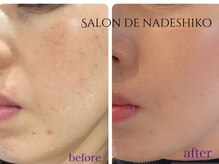 サロン ド ナデシコ(Salon de Nadeshiko)/ハーブピーリング
