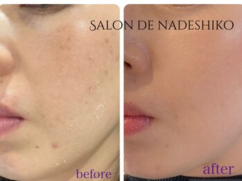 サロン ド ナデシコ(Salon de Nadeshiko)/ハーブピーリング