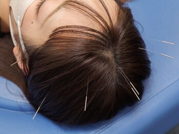 あおぞら整骨院 上大岡院/脳天の鍼