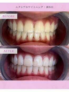 エクシアホワイトニング 調布店/20代女性会員様/ブライダルケア
