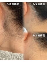 サロンドベルム(Salon de BELME)/ダブル脱毛：施術効果