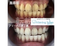 ホワイトニングサロン 福岡天神店/ホワイトニング