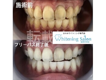 ホワイトニングサロン 福岡天神店/ホワイトニング