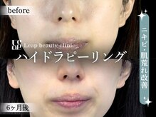 リープ(Leap)/ハイドラピーリング