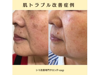ピーナップ(P-nap)の写真