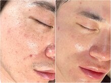 シシエル(CHICIEL)の雰囲気（ヒゲ脱毛で肌質改善、毎朝のヒゲ剃りから解放されて優雅な朝を♪）