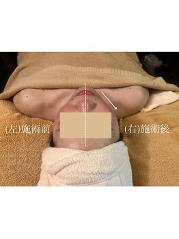 ヒヨリ(hiyori)/《before/after》フェイシャル