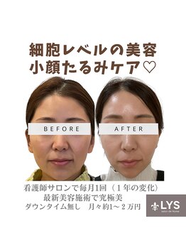 リスサロンドナース(LYS salon de Nurse)/小顔サーマ脂肪燃焼!たるみケア