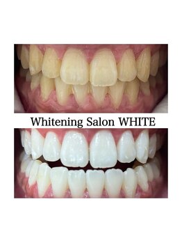 ホワイトニングサロン ホワイト 天童店(WHITE)/圧倒的な白さのホワイトニング