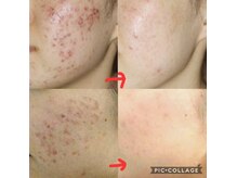 ベビースキン(baby skin)/ニキビ肌改善